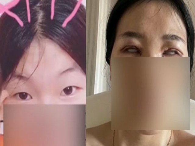 Người phụ nữ bị chồng đòi ly hôn sau khi đi cắt mí mắt